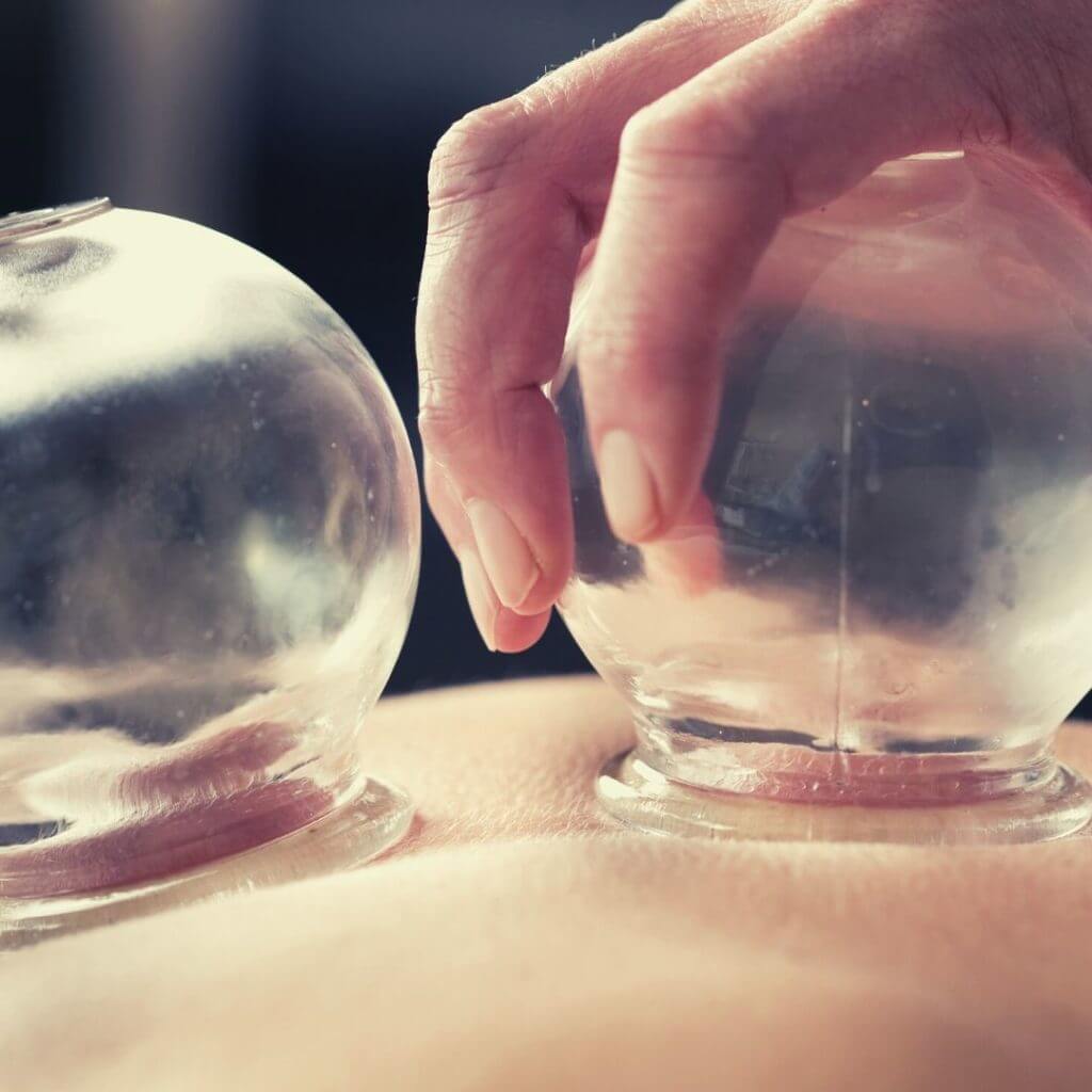 Practitioner demonstrating cupping treatment
